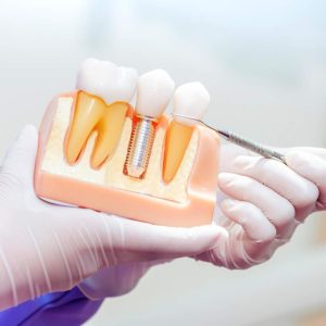 Implantes